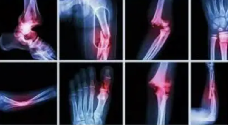 Orthopaedic Fractures Image