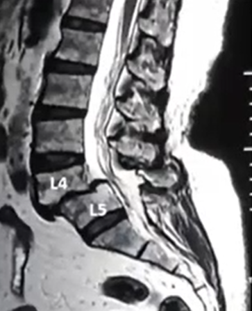 Spondylolisthesis