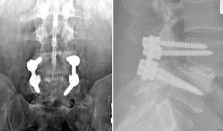 PLIF (Posterior Lumbar Interbody Fusion)