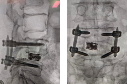MIS – TLIF (Minimally invasive surgery) (Pedicle Screw fixation and Interbody cage)