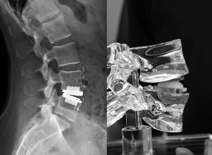 Lumbar Disc replacement