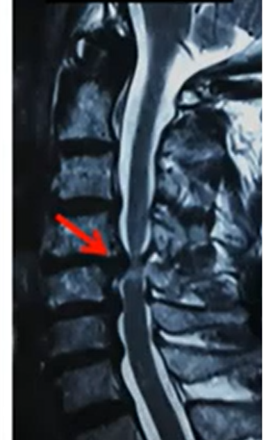 Cervical Myelopathy
