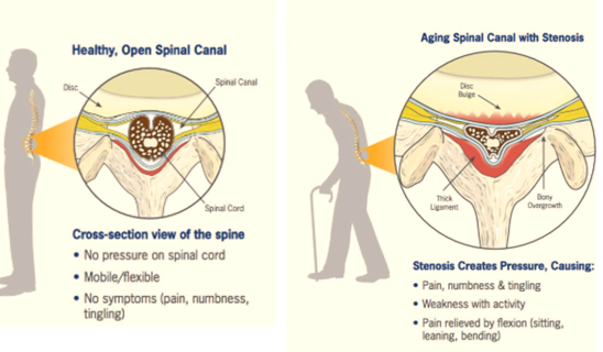 Lumbar Canal Synosis