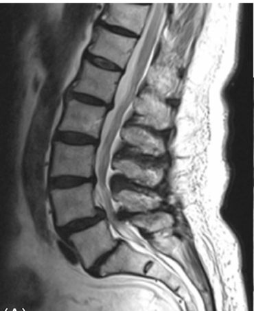 MRI (Lumbar Canal Stenosis)