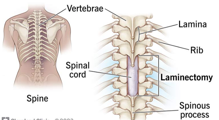 Laminectomy