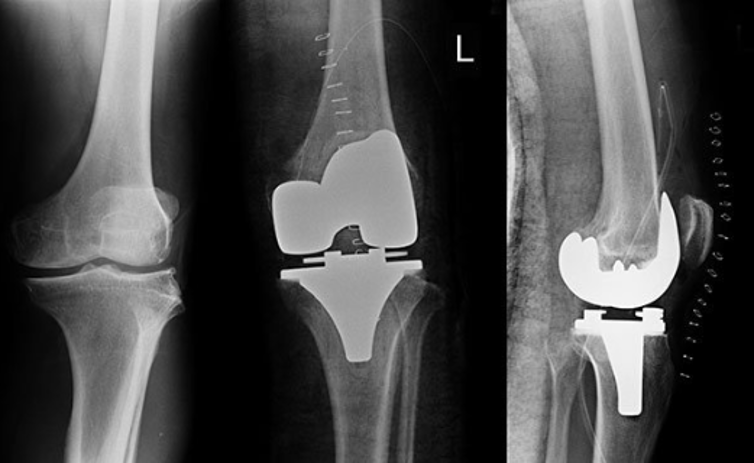 Total knee replacement