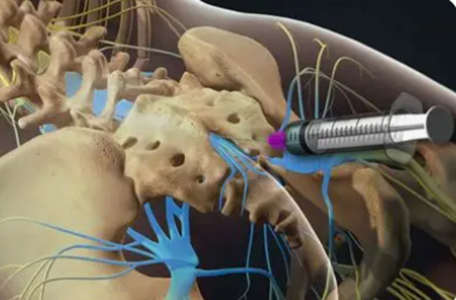 Spinal Injection Therapy