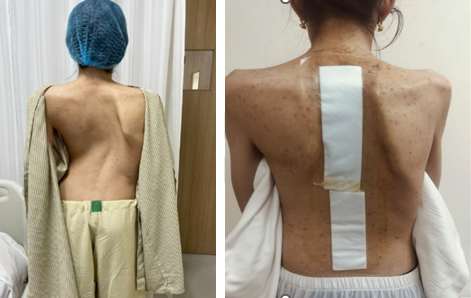 Scoliosis Surgery