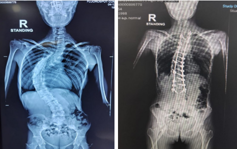 Scoliosis Surgery