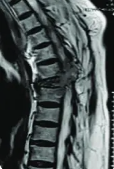 Burst fracture with conus medullaris syndrome