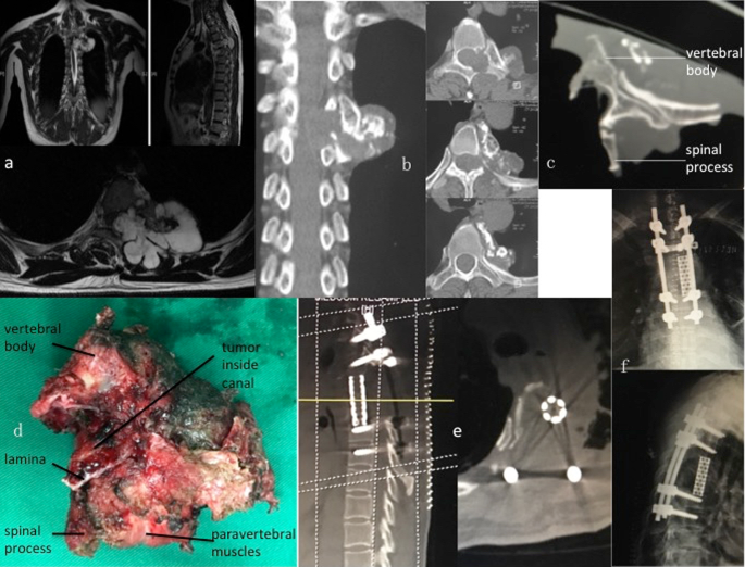 Tumors in the thoracic and lumbar spine